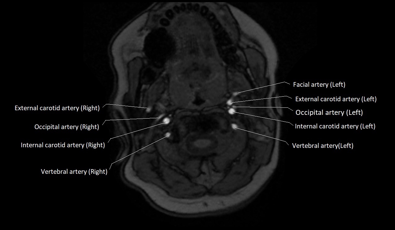 Carotid artery anatomy axial 3T image 16.jpg